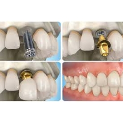 IMPLANT sau nhổ răng